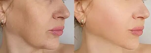 女性在治疗前后会出现皱纹 女性在治疗前后会出现皱纹 除皱前后 库存图片、免版税照片和图片