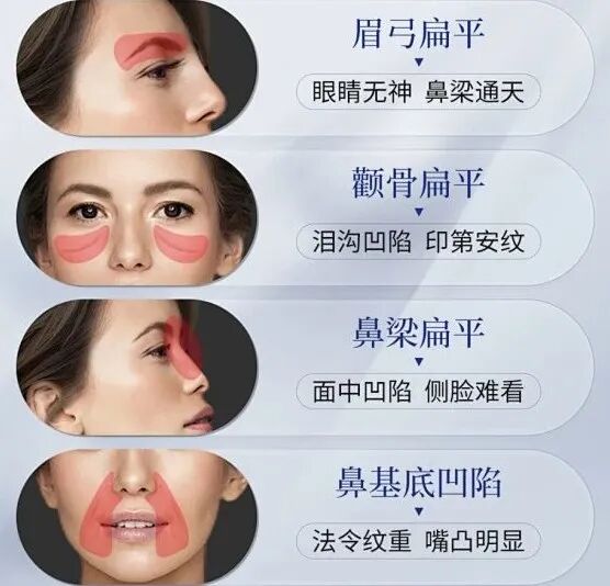 轮廓固定内轮廓固定 (1)