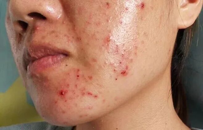 痘痘内的花瓣采集图片-小小设计、